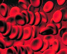 The accumulation of ketone bodies in the blood in diabetes